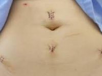 Laparoscopic Myomectomy