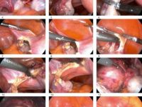 Laparoscopic Myomectomy