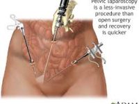 Laparoscopic Ouary Tumor Remoul