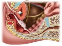 Laparoscopic valut Sacropexy