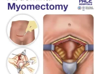 Myomectomy